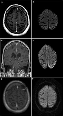 Rheumatoid Meningitis Presenting With Acute Parkinsonism and Protracted Non-convulsive Seizures: An Unusual Case Presentation and Review of Treatment Strategies